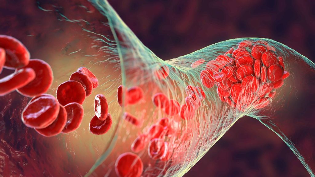Blood Clot in a Vein