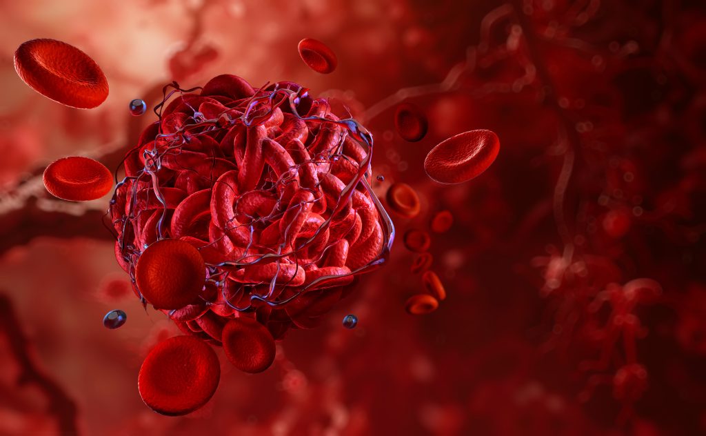 Blood clot in artery, emphasizing thrombosis, coagulation process